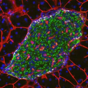 Images of islets of Langerhans in a mouse pancreas taken with a confocal microscope. Green GFP (marker for mutant beta cells lacking the ADAR gene), white IBA1 (marker of macrophages), red CD3 (marker of T cells), blue DNA.