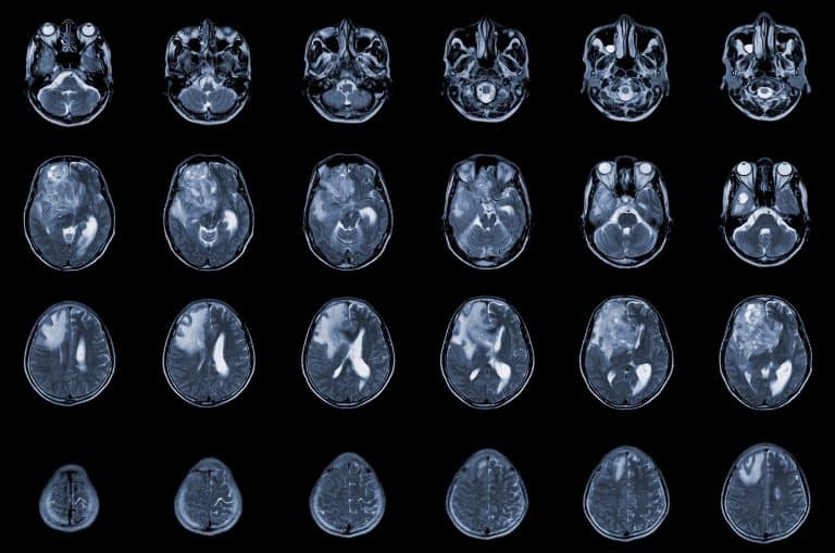 צילום MRI צירי של המוח, שבו נראה ממצא המתואר כ־glioblastoma / brain metastasis, עם מסה ותגובה סביבתית באונה הקדמית הימנית.