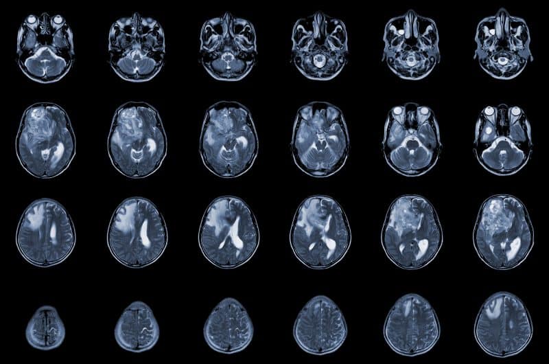 צילום MRI צירי של המוח, שבו נראה ממצא המתואר כ־glioblastoma / brain metastasis, עם מסה ותגובה סביבתית באונה הקדמית הימנית.